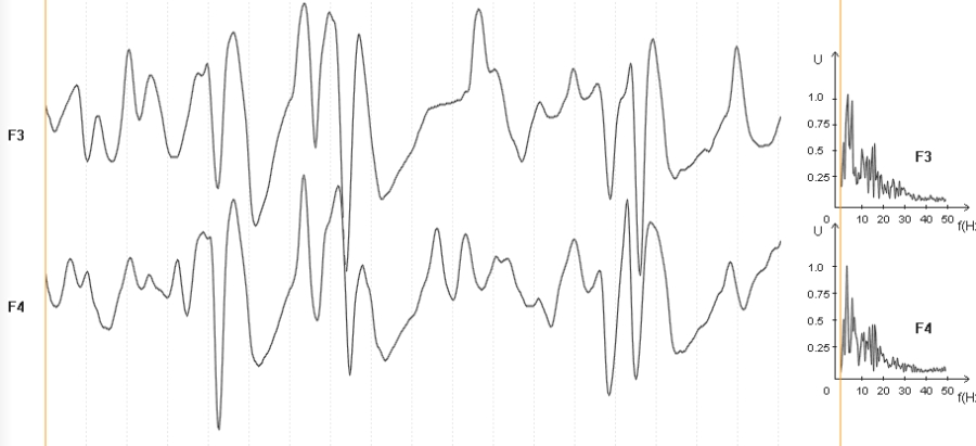 Рис.3 Комплексы типа пик-волна при увеличении в четыре раза. Справа – энергетические спектры. Демонстрация качества регистрации ЭЭГ.