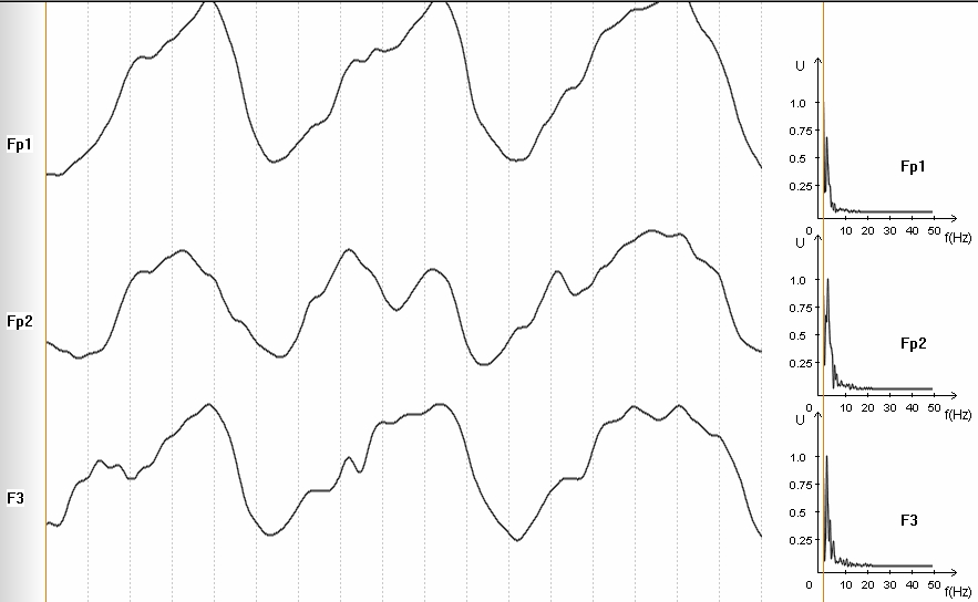 Рис.5 Медленные волны при увеличении в четыре раза. Демонстрация корректности отображения медленноволновой активности. Высокочастотная активность редуцирована – обратите внимание на спектры.