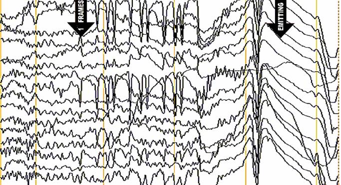 Fig.3. The noise in EEG when turning on the cellular phone. The patient's eyes are closed. The observation of </p>
<p>electrophysiological laboratory of Central Clinical Hospital N5 (Kharkov, Ukraine).